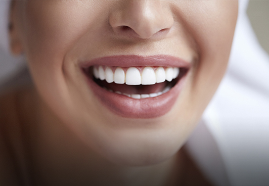 veneers